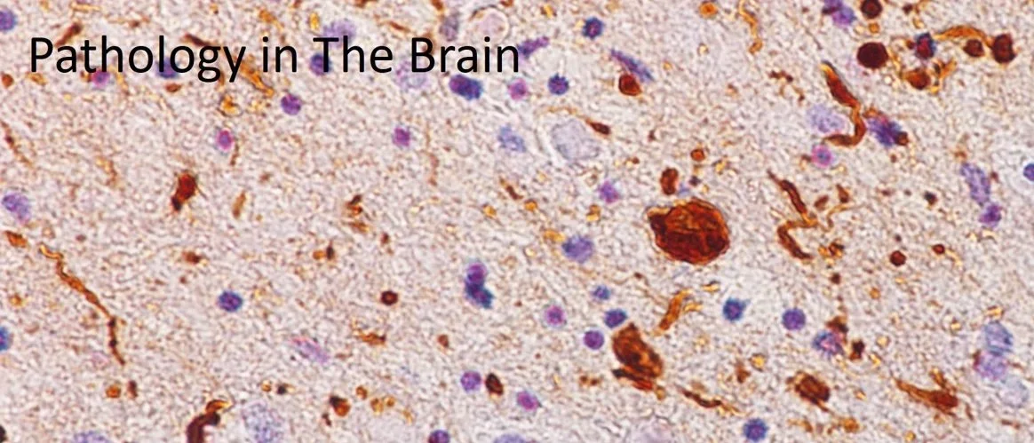 Beige, red, and purple illustration of pathology of brain.