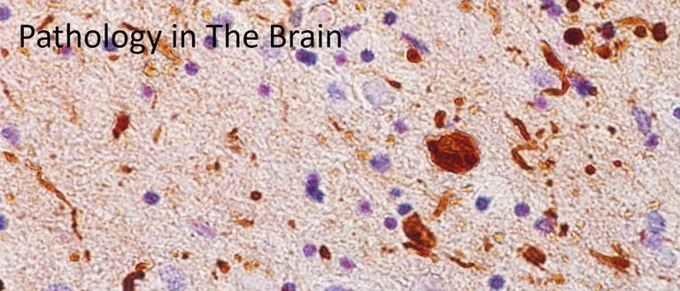 Beige, red, and purple illustration of pathology of brain.